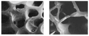 3-osso-normale-osteoporotico