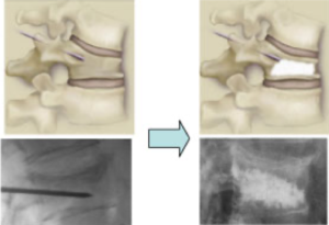 3-vertebroplastica