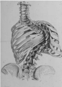 5-grave-scoliosi