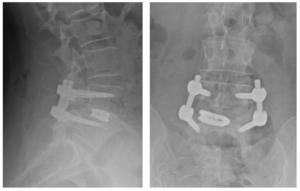 7-rx-postoperatoria-decompressione+L4