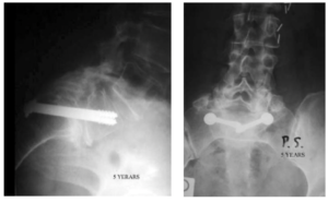 7-rx-postoperatoria-decompressione+L5