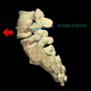 7-spondilolistesi